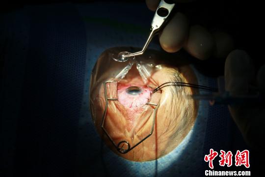 医疗队采用的手术，切口只有3毫米左右，不用缝针。采用超声波将晶状体粉碎成乳糜状，再连同皮质一起吸出。 植入的折叠型后房型人工晶体，有很好的亲水性。 患者相当于更换了眼睛浑浊了的光学部件，得以复明。　关向东 摄