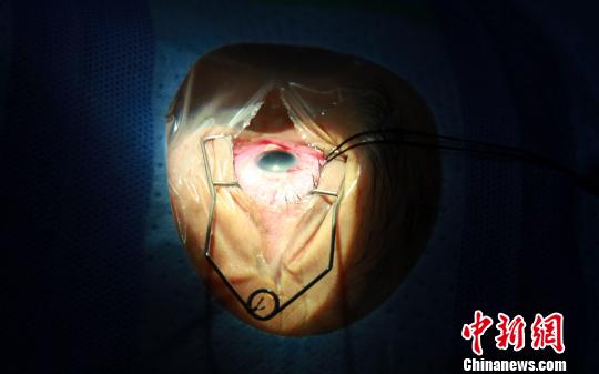 目击小切口超声乳化白内障复明手术（图）