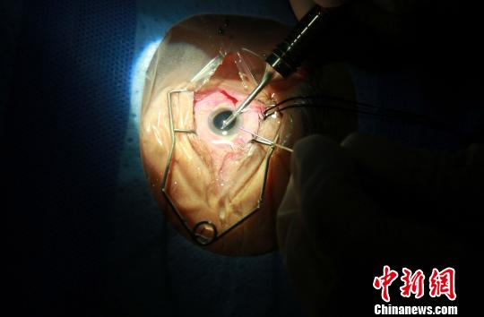 手术切口只有3毫米左右，不用缝针。采用超声波将晶状体粉碎成乳糜状，再连同皮质一起吸出。　关向东 摄